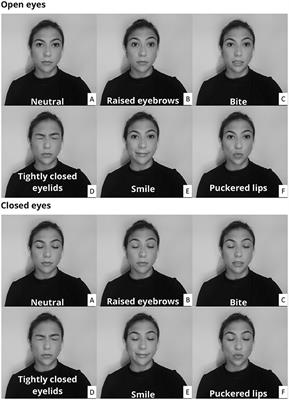 Single channel approach for filtering electroencephalographic signals strongly contaminated with facial electromyography